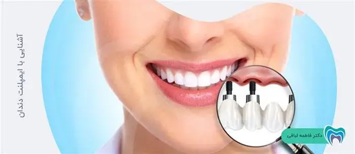 با ایمپلنت دندان بیشتر آشنا شوید