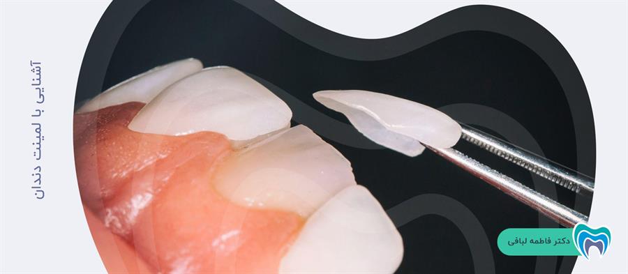 لمینت سرامیکی دندان چیست؟