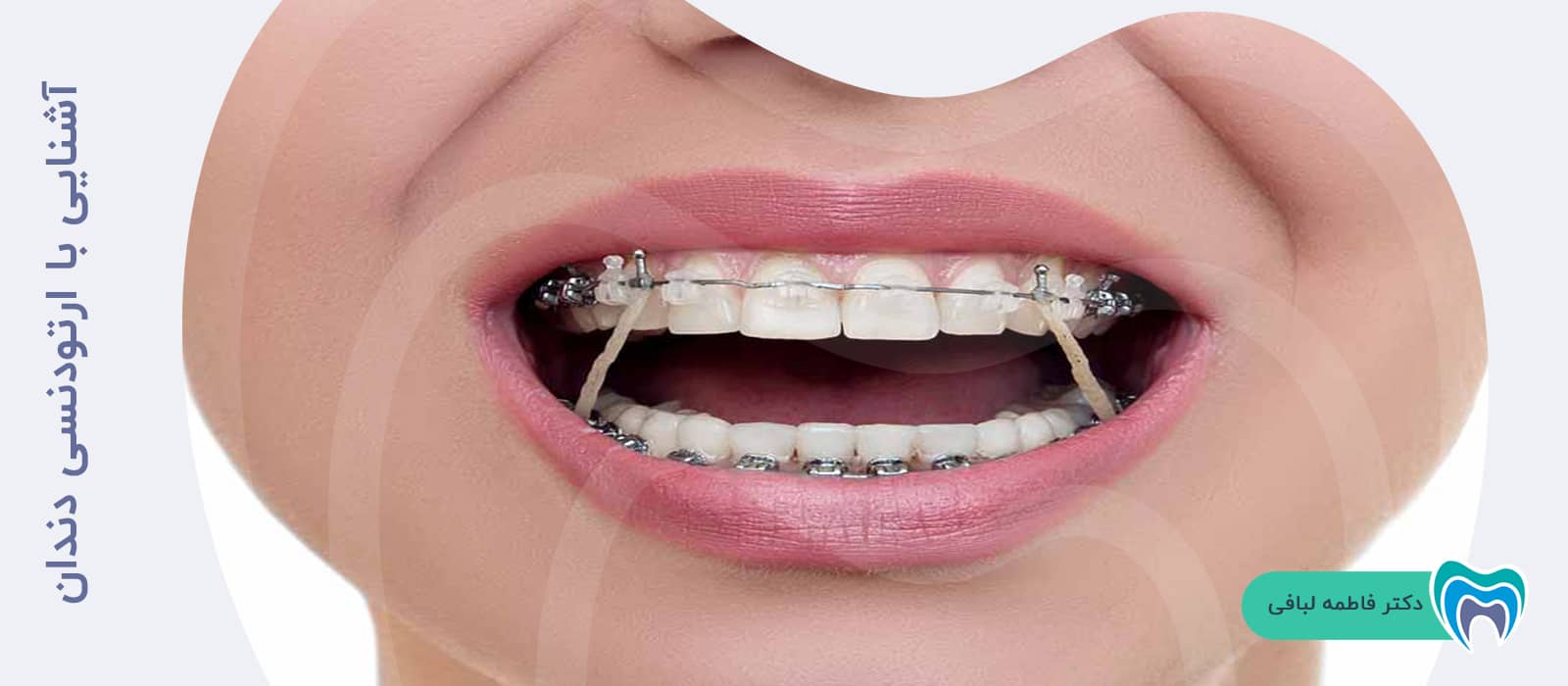آشنایی با ارتودنسی دندان