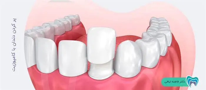 پر کردن دندان با کامپوزیت 