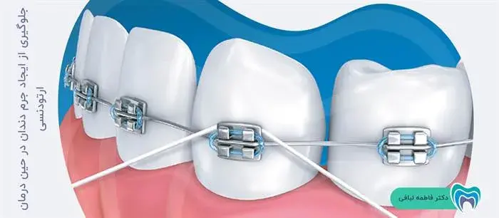 روش‌های پیشگیری از تشکیل جرم بر روی دندان ارتودنسی شده