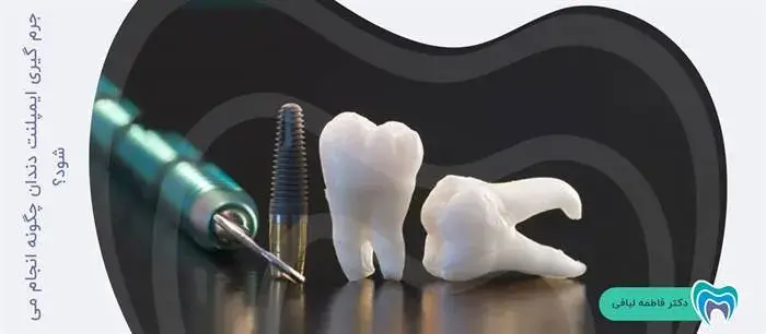نحوه انجام جرم گیری ایمپلنت دندان چگونه است؟