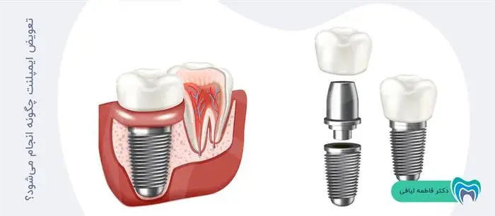 چگونگی انجام تعویض ایمپلنت دندان