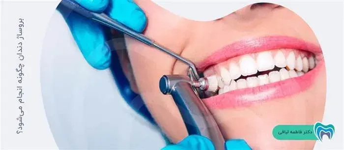 نحوه انجام بروساژ دندان