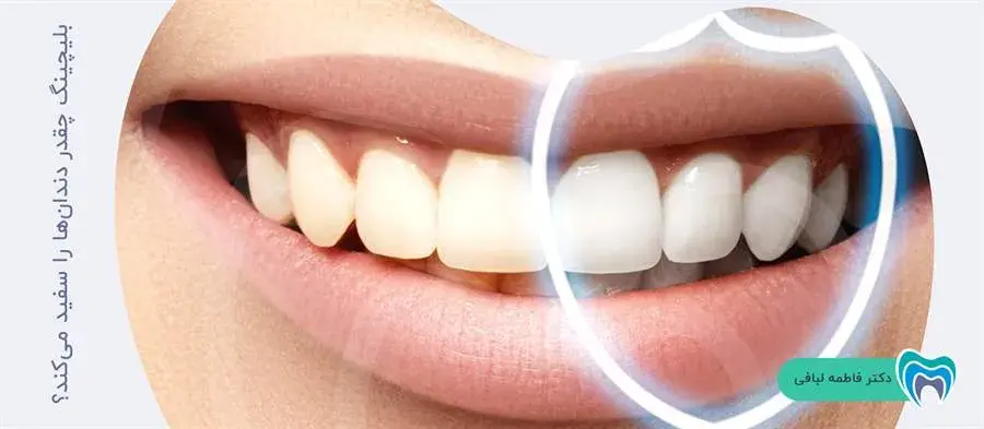 میزان سفید شدن دندانها با بلیچینگ