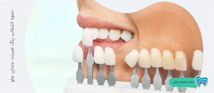 چگونه رنگ لمینت دندان جلو را انتخاب کنیم؟