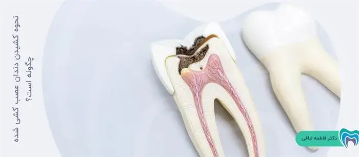 دندان عصب کشی شده چگونه کشیده می‌شود؟