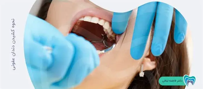 نحوه کشیدن دندان عفونی چگونه است؟