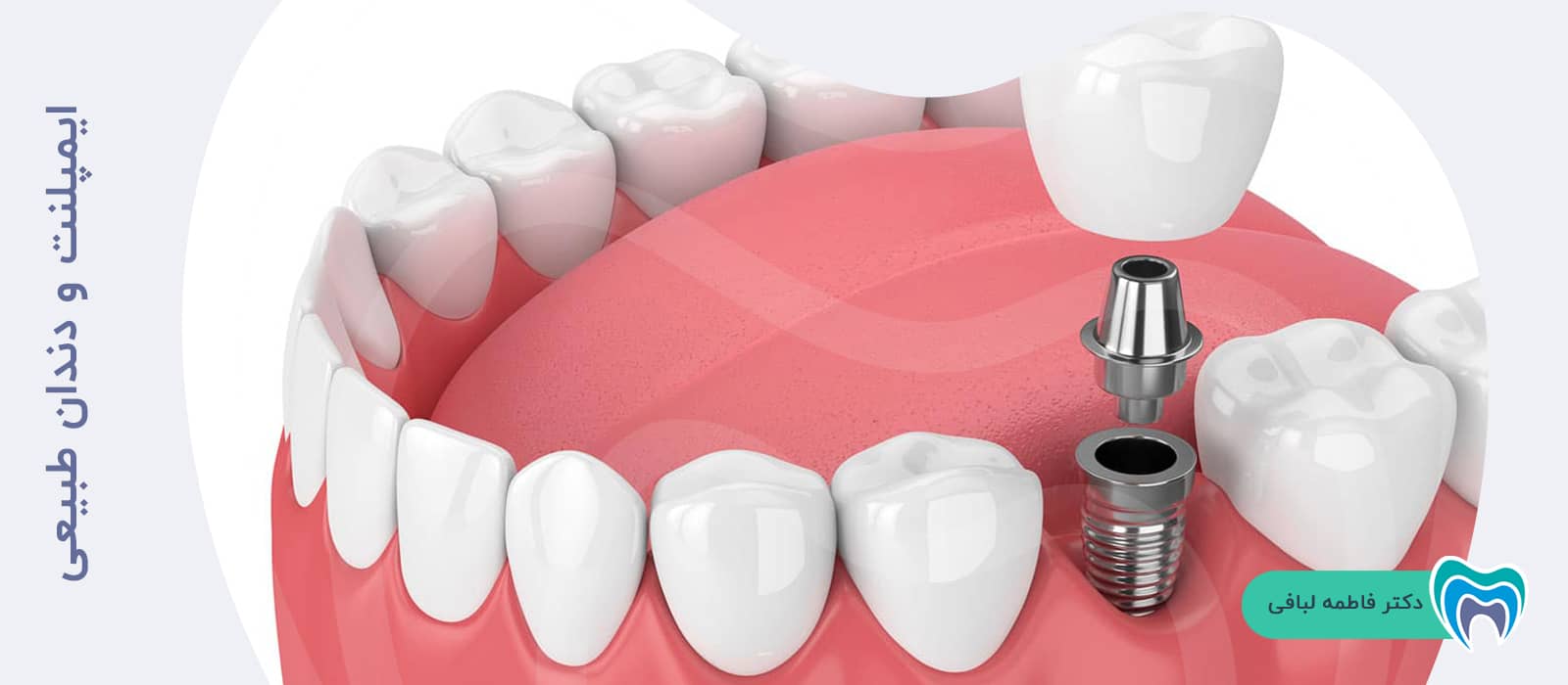 ایمپلنت و دندان طبیعی
