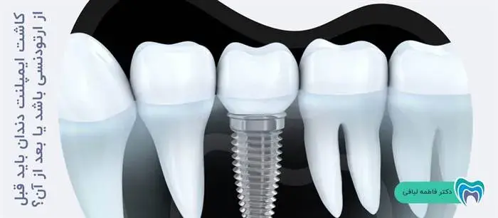کاشت ایمپلنت دندان باید قبل از ارتودنسی باشد یا بعد از آن؟