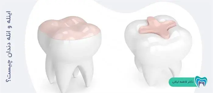 اینله و انله دندان چیست؟
