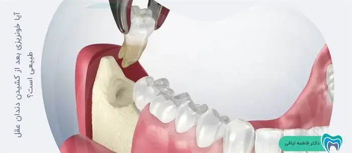 آیا خونریزی بعد از کشیدن دندان عقل خطرناک است؟