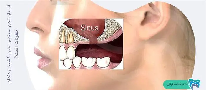 آیا باز شدن سینوس حین کشیدن دندان نگران کننده است؟