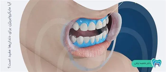 آیا مایکروابریژن برای دندان‌های شما خوب است؟