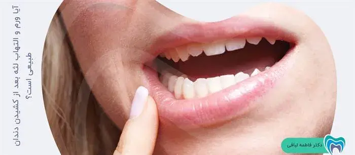 آیا ورم و التهاب لثه و صورت بعد از کشیدن دندان خطرناک است؟