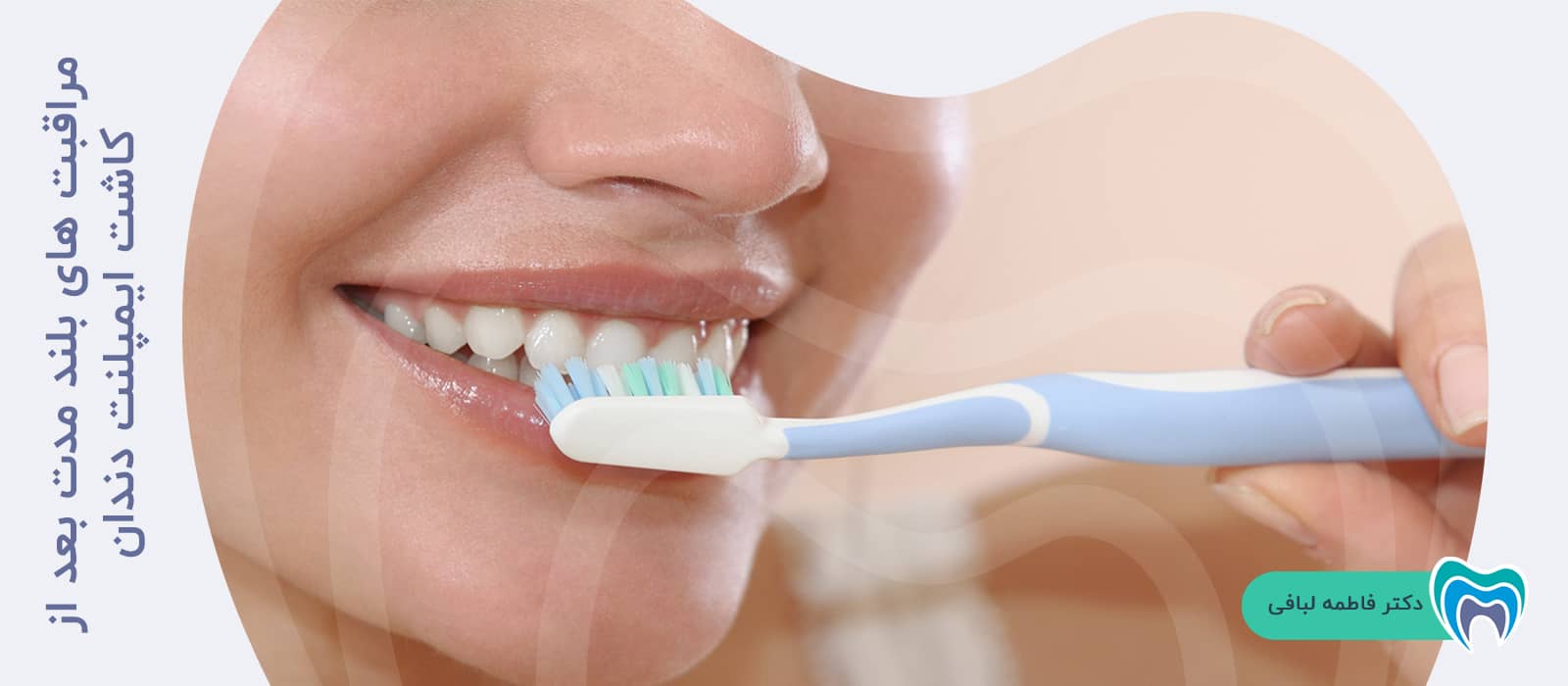 مراقبت های بلند مدت بعد از کاشت ایمپلنت دندان