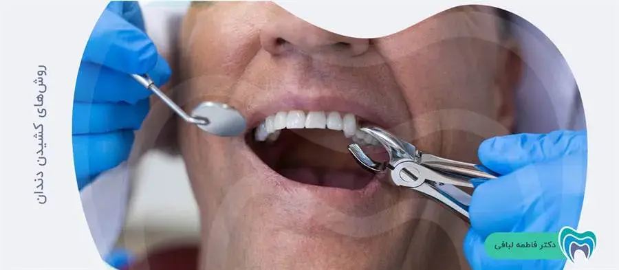 چه روشهایی برای کشیدن دندان وجود دارد؟