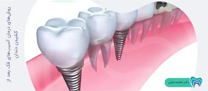 آسیب فک بعد از کشیدن دندان چگونه درمان می‌شود؟