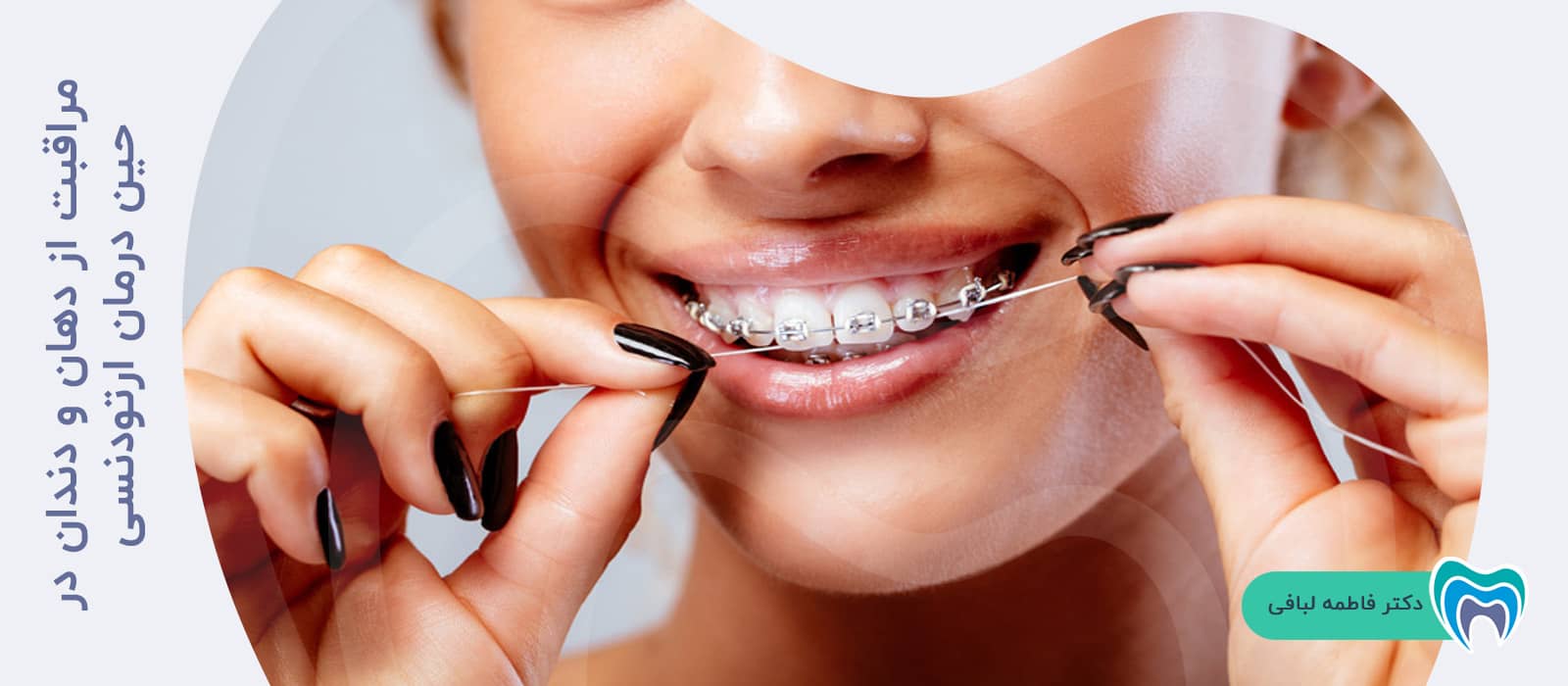 مراقبت از دهان و دندان در حین درمان ارتودنسی