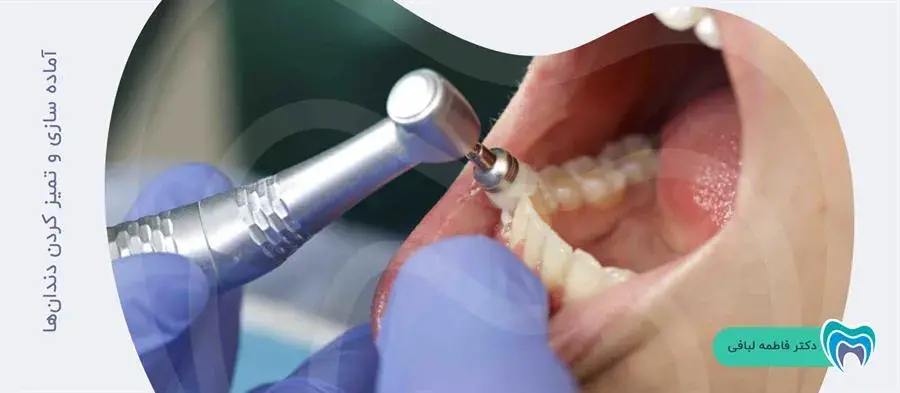 چگونه دندانها برای کامپوزیت آماده می شوند؟