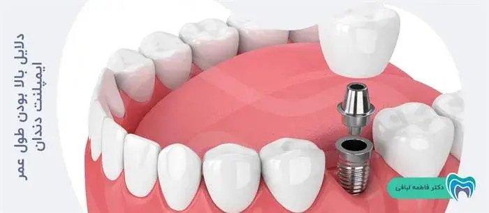 دلایل بالا بودن طول عمر ایمپلنت دندان