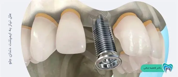 علل نیاز به ایمپلنت دندان جلو