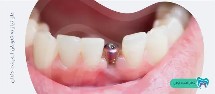 علل نیاز به تعویض ایمپلنت دندان