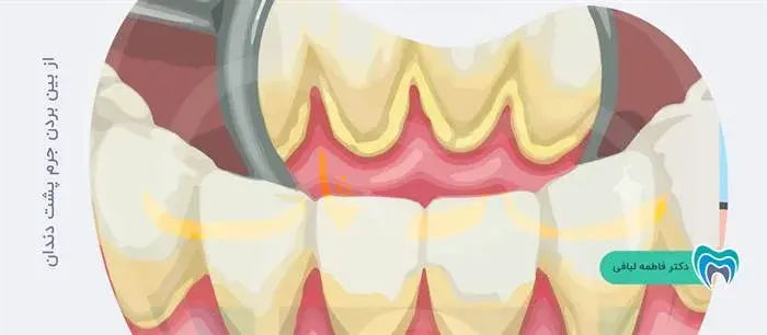 چگونه جرم پشت دندان را از بین ببریم؟