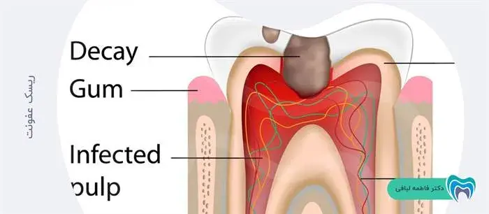 عفونت دندان از علائم نیاز به کشیدن دندان در بارداری