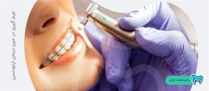 جرم گیری دندان در حین درمان ارتودنسی