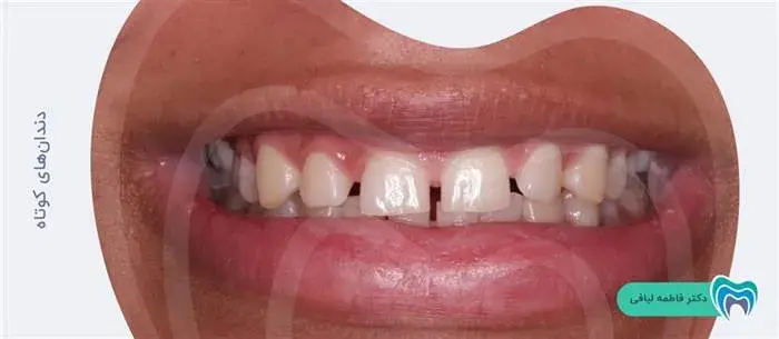 دندانهای کوتاه با کمک کامپوزیت زیباتر می شوند.