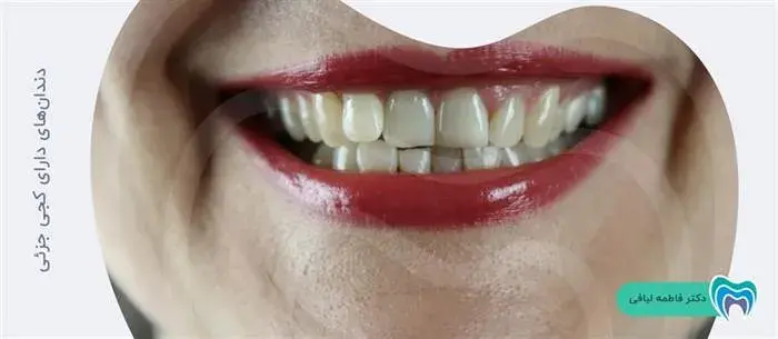 آیا کامپوزیت برای دندانهای کج مناسب است؟