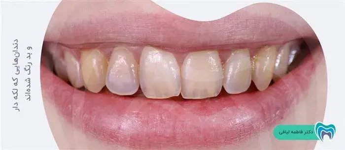 درمان دندانهای بد رنگ و لکه دار با لمینت