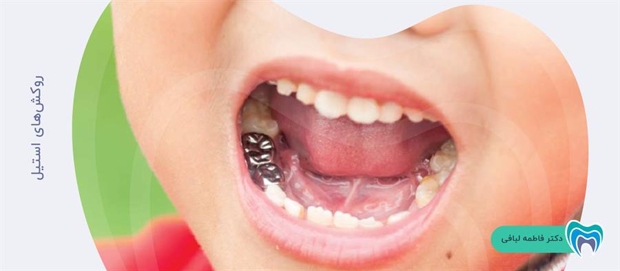 ویژگی های روکش دندان استیل