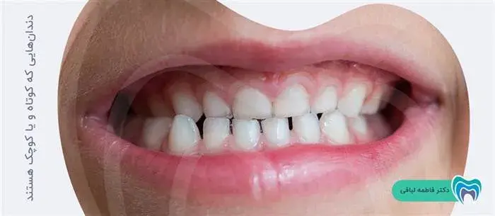 درمان دندانهای کوتاه با لمینت سرامیکی