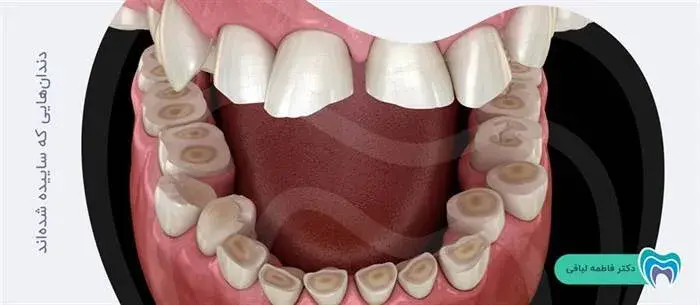 درمان دندانهای ساییده شده با لمینت سرامیکی