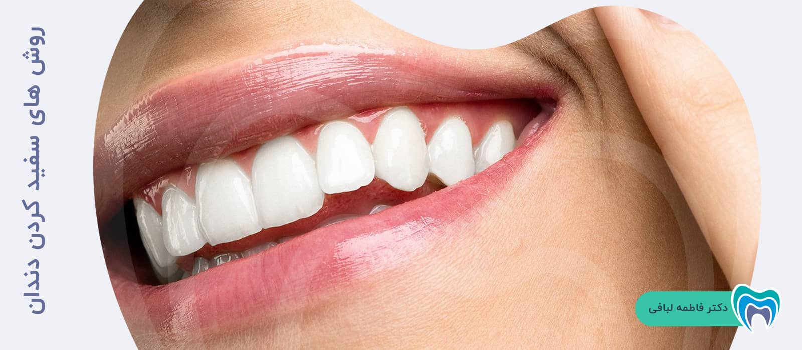 با چه روش‌هایی می‌توان دندان‌ها را سفید کرد؟