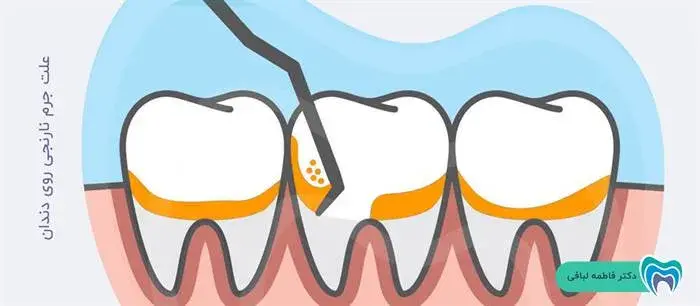 علت تشکیل جرم نارنجی روی دندان چیست؟