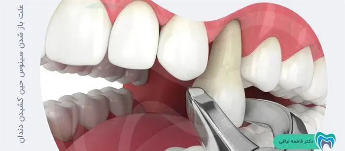 سوراخ شدن سینوس حین کشیدن دندان به چه علت است؟