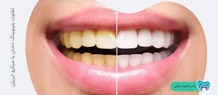 تفاوت بلیچینگ دندان با میکرو ابریژن چیست؟