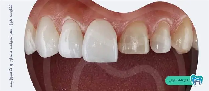 تفاوت طول عمر لمینت دندان و کامپوزیت