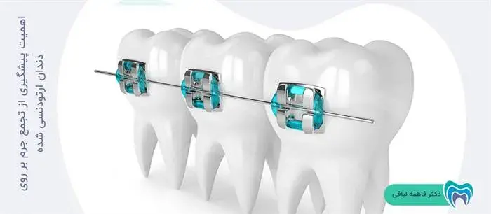 چرا پیشگیری از تشکیل جرم بر روی دندان ارتودنسی شده مهم است؟
