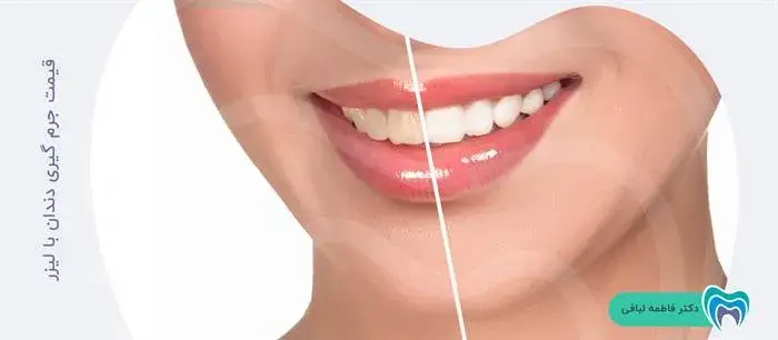 هزینه جرم گیری دندان با لیزر چقدر است؟