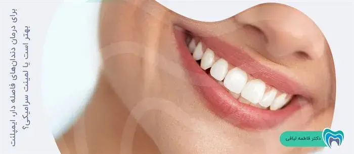 برای درمان دندان‌های فاصله دار، ایمپلنت بهتر است یا لمینت سرامیکی؟
