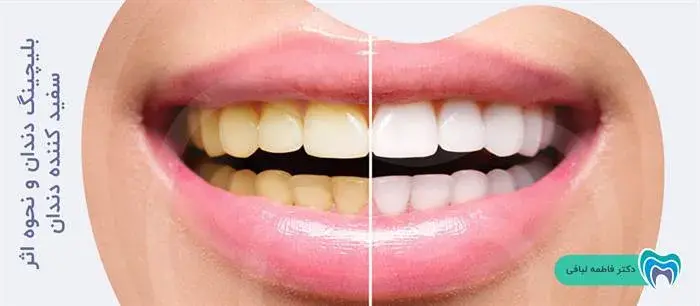 بلیچینگ دندان و نحوه اثر سفید کننده دندان
