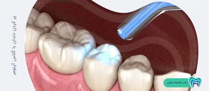 پر کردن دندان با گلاس آینومر چگونه است؟