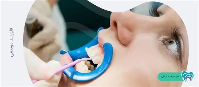 استفاده از فلوراید موضعی برای از بین بردن لکه های روی دندان