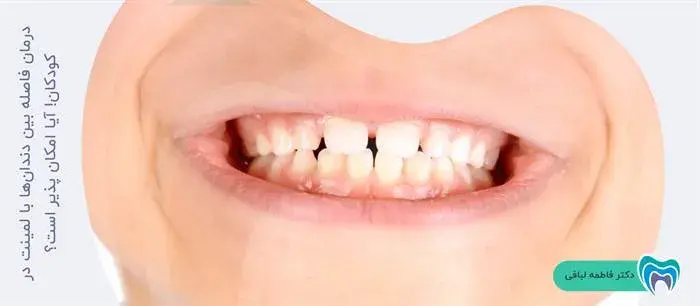 درمان فاصله بین دندان‌ها با لمینت در کودکان