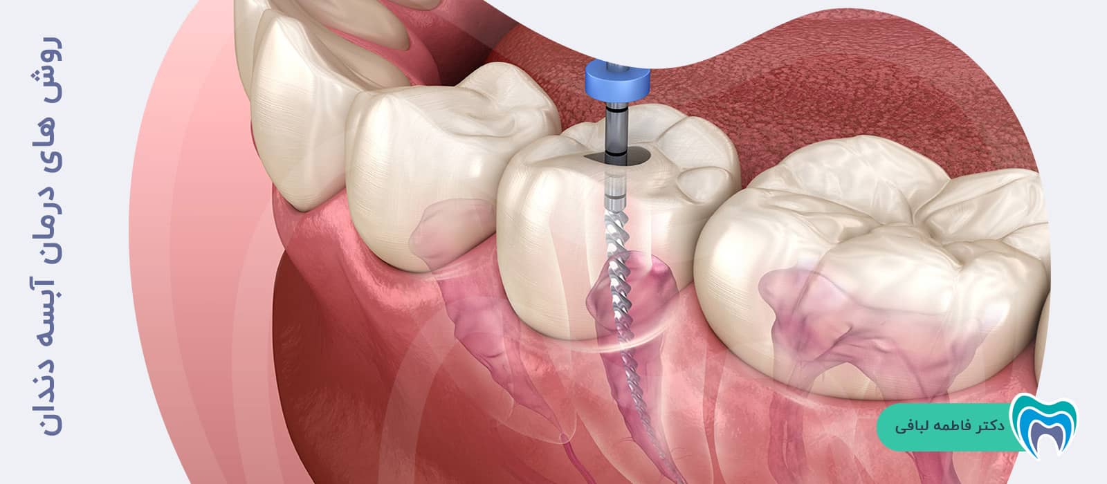 روش های درمان آبسه دندان