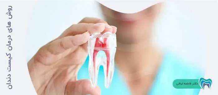 روش های درمان کیست دندان